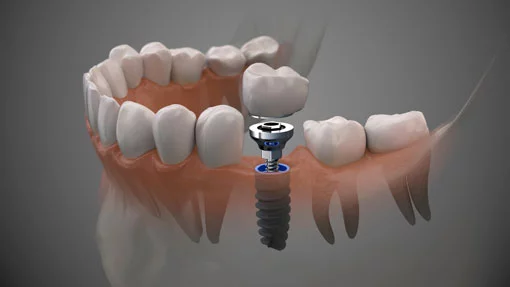 Les implants au centre dentaire Jean Jaurès
