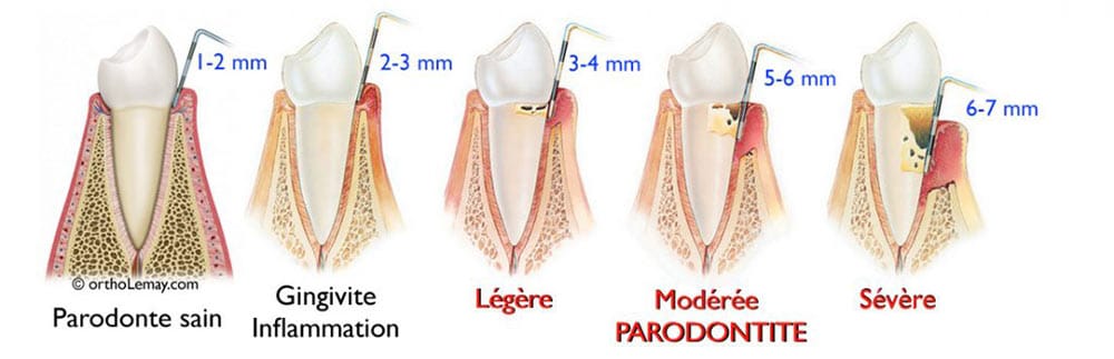 L'évolution de la parodontie