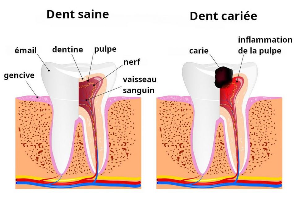 Différence entre une dent sainte et une dent cariée