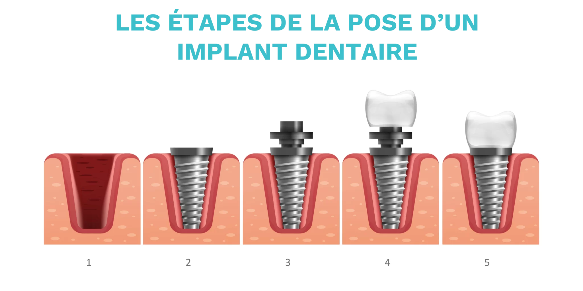 Les étapes de la pose des implants dentaire
