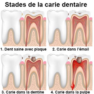 Les différents stades de caries