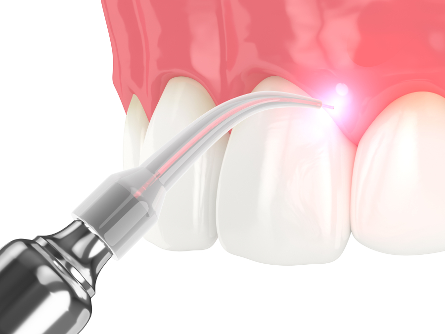 Utilisation d'un laser dentaire sur des dents