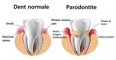 Différence entre une dent normale et une dent atteinte de parodontite
